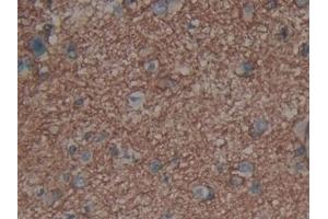 Detection of AQP4 in Human Glioma Tissue using Polyclonal Antibody to Aquaporin 4 (AQP4)