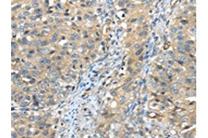 The image on the left is immunohistochemistry of paraffin-embedded Human breast cancer tissue using ABIN7191125(ISM2 Antibody) at dilution 1/45, on the right is treated with synthetic peptide. (Isthmin 2 anticorps)