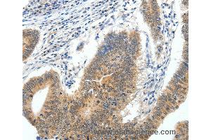 Immunohistochemistry of Human gastric cancer using ECE2 Polyclonal Antibody at dilution of 1:40 (ECE2 anticorps)