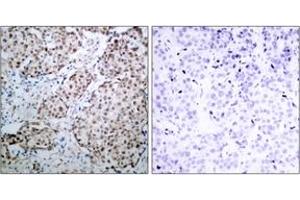 Immunohistochemistry analysis of paraffin-embedded human breast carcinoma, using p53 (Phospho-Ser315) Antibody.