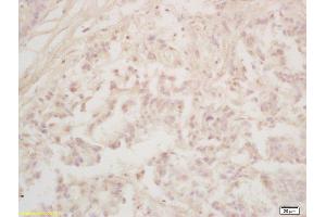 Formalin-fixed and paraffin embedded human gastric carcinoma labeled with Rabbit Anti Runx3 Polyclonal Antibody, Unconjugated (ABIN1714069) at 1:200 followed by conjugation to the secondary antibody and DAB staining