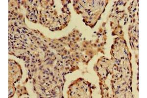 Immunohistochemistry of paraffin-embedded human lung cancer using ABIN7143798 at dilution of 1:100 (A2ML1 anticorps  (AA 625-751))