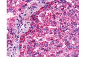 Anti-BAI1 antibody IHC of human Lung, Adenocarcinoma.