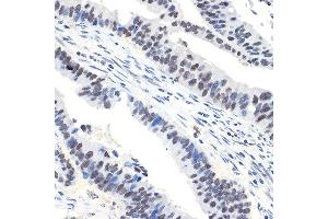 Immunohistochemistry of paraffin-embedded human colon carcinoma using N Rabbit mAb (ABIN7268774) at dilution of 1:100 (40x lens). (NAT10 anticorps)