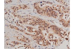 ABIN6267520 at 1/50 staining human colon cancer tissue sections by IHC-P.