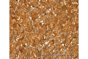 Immunohistochemistry of Human liver cancer using PYGM Polyclonal Antibody at dilution of 1:30 (PYGM anticorps)