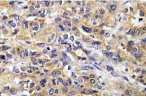 Immunohistochemistry (IHC) analyzes of COX17 antibody in paraffin-embedded human liver carcinoma tissue. (COX17 anticorps)