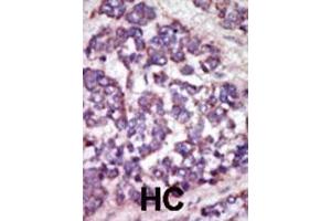 Formalin-fixed and paraffin-embedded human cancer tissue reacted with the primary antibody, which was peroxidase-conjugated to the secondary antibody, followed by AEC staining.