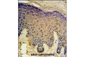 HAUS4 Antibody (C-term) (ABIN651422 and ABIN2840229) IHC analysis in formalin fixed and paraffin embedded skin carcinoma followed by peroxidase conjugation of the secondary antibody and DAB staining. (C14orf94 anticorps  (C-Term))