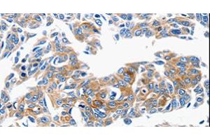 Immunohistochemistry of paraffin-embedded Human lung cancer tissue using CCL6 Polyclonal Antibody at dilution 1:50 (CCL6 anticorps)