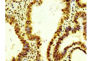 IHC image of ABIN7127297 diluted at 1:100 and staining in paraffin-embedded human colon cancer performed on a Leica BondTM system.