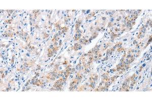 Immunohistochemistry of paraffin-embedded Human gastric cancer tissue using PAPSS1 Polyclonal Antibody at dilution 1:40 (PAPSS1 anticorps)