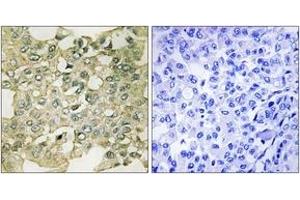 Immunohistochemistry analysis of paraffin-embedded human breast carcinoma, using MYT1 (Phospho-Ser83) Antibody.