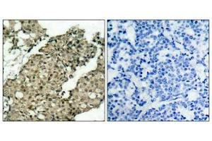 Immunohistochemical analysis of paraffin-embedded human breast carcinoma tissue using G3BP-1(Phospho-Ser232) Antibody(left) or the same antibody preincubated with blocking peptide(right). (G3BP1 anticorps  (pSer232))