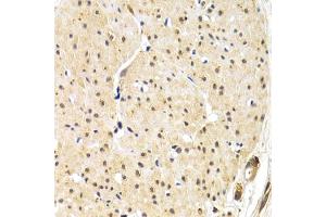 Immunohistochemistry of paraffin-embedded human gastric cancer using TERF1 antibody (ABIN1683138, ABIN3015078, ABIN3015079 and ABIN6213631) at dilution of 1:200 (40x lens). (TRF1 anticorps  (AA 240-419))