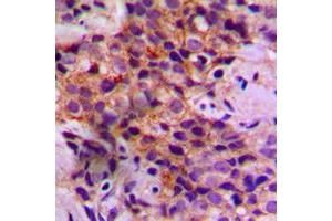Immunohistochemical analysis of Caspase 2 staining in human breast cancer formalin fixed paraffin embedded tissue section. (Caspase 2 anticorps  (Center))