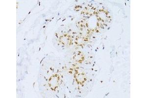 Immunohistochemistry of paraffin-embedded Human breast using ZEB2 Polyclonal Antibody at dilution of 1:100 (40x lens). (ZEB2 anticorps)