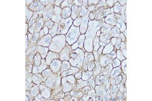 Immunohistochemistry of paraffin-embedded human esophageal cancer using [KO Validated] CD44 Rabbit pAb (ABIN6127602, ABIN6138193, ABIN6138195 and ABIN7101398) at dilution of 1:250 (40x lens).