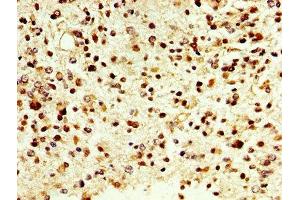 IHC image of ABIN7149450 diluted at 1:500 and staining in paraffin-embedded human glioma cancer performed on a Leica BondTM system.