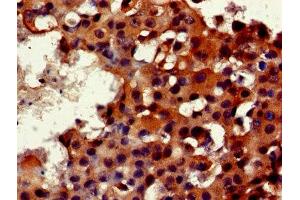 Immunohistochemistry of paraffin-embedded human breast cancer using ABIN7162833 at dilution of 1:100