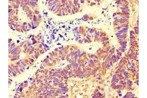 Immunohistochemistry of paraffin-embedded human ovarian cancer using ABIN7169495 at dilution of 1:100 (SH3BP5 anticorps  (AA 49-455))