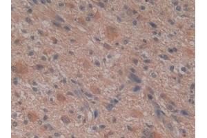 Detection of GSTm4 in Human Glioma Tissue using Polyclonal Antibody to Glutathione S Transferase Mu 4 (GSTm4)