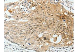 The image on the left is immunohistochemistry of paraffin-embedded Human cervical cancer tissue using ABIN7193012(VEGFA Antibody) at dilution 1/25, on the right is treated with synthetic peptide. (VEGFA anticorps)