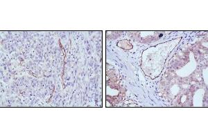 Immunohistochemical analysis of paraffin-embedded human stomach cancer (left) and ovary cancer (right) tissues using eNOS mouse mAb with DAB staining. (ENOS anticorps)