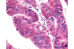 Anti-ACKR4 / CCRL1 / CCR11 antibody IHC of human Colon, Carcinoma. (CCRL1 anticorps  (Cytoplasmic Domain))