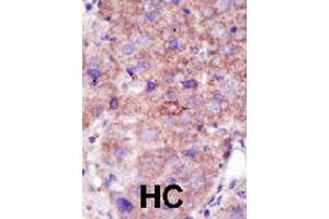 Formalin-fixed and paraffin-embedded human hepatocellular carcinoma tissue reacted with SMURF2 polyclonal antibody  , which was peroxidase-conjugated to the secondary antibody, followed by DAB staining. (SMURF2 anticorps  (AA 702-731))