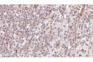 ABIN6273204 at 1/100 staining Human lymph cancer tissue by IHC-P. (CALCOCO2 anticorps  (Internal Region))