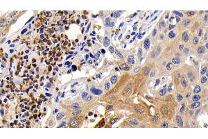 Detection of Bcl2L in Human Lung cancer Tissue using Monoclonal Antibody to B-Cell CLL/Lymphoma 2 Like Protein (Bcl2L)