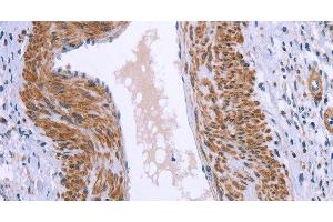 Immunohistochemistry of paraffin-embedded Human cervical cancer tissue using GNPAT Polyclonal Antibody at dilution 1:40 (GNPAT anticorps)