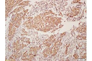 Formalin-fixed and paraffin embedded human lung carcinoma labeled with Anti-CHRM4/mAChR M4 Polyclonal Antibody, Unconjugated (ABIN1387838) at 1:200, followed by conjugation to the secondary antibody and DAB staining (CHRM4 anticorps  (AA 1-31))