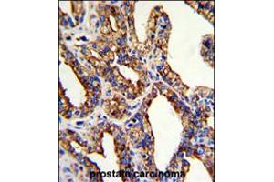 Formalin-fixed and paraffin-embedded human prostate carcinoma with TROP2 Antibody , which was peroxidase-conjugated to the secondary antibody, followed by DAB staining. (TACSTD2 anticorps  (AA 162-190))