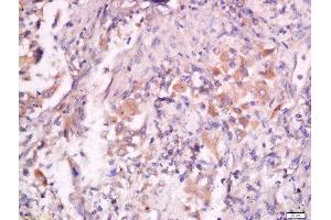 Formalin-fixed and paraffin embedded human lung carcinoma labeled with Anti- Pan FOXD Polyclonal Antibody, Unconjugated  at 1:200 followed by conjugation to the secondary antibody and DAB staining. (FOXD (AA 131-230) anticorps)