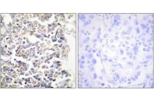 Immunohistochemistry analysis of paraffin-embedded human lung carcinoma tissue, using MARK3 Antibody. (MARK3 anticorps  (AA 1-50))