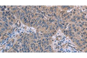 Immunohistochemistry of paraffin-embedded Human lung cancer using p53RFP Polyclonal Antibody at dilution of 1:50