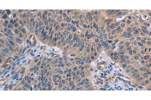 Immunohistochemistry of paraffin-embedded Human lung cancer using p53RFP Polyclonal Antibody at dilution of 1:50 (RNF144B anticorps)