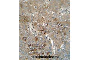 CES4 antibody (N-term) immunohistochemistry analysis in formalin fixed and paraffin embedded human hepatocarcinoma followed by peroxidase conjugation of the secondary antibody and DAB staining. (CES1P1 anticorps  (N-Term))