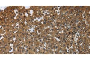 Immunohistochemistry of paraffin-embedded Human breast cancer tissue using PTPRM Polyclonal Antibody at dilution 1:40