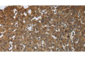 Immunohistochemistry of paraffin-embedded Human breast cancer tissue using PTPRM Polyclonal Antibody at dilution 1:40 (PTPRM anticorps)