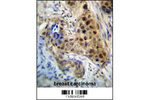RPL3 Antibody immunohistochemistry analysis in formalin fixed and paraffin embedded human breast carcinoma followed by peroxidase conjugation of the secondary antibody and DAB staining. (RPL3 anticorps  (AA 224-251))