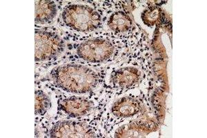 Immunohistochemical analysis of Villin staining in human colon cancer formalin fixed paraffin embedded tissue section. (Villin 1 anticorps)