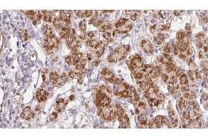 ABIN6278853 at 1/100 staining Human liver cancer tissue by IHC-P. (CALY anticorps  (Internal Region))