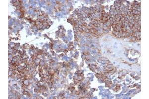 Formalin-fixed, paraffin-embedded human ovarian carcinoma stained with N-Cadherin Recombinant Rabbit Monoclonal Antibody (CDH2/6857R). (Recombinant N-Cadherin anticorps)