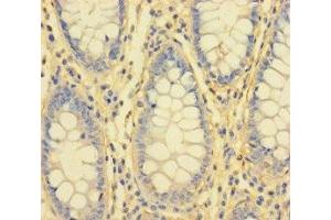 Immunohistochemistry of paraffin-embedded human colon cancer using ABIN7156759 at dilution of 1:100 (IL1RL2 anticorps  (AA 20-218))