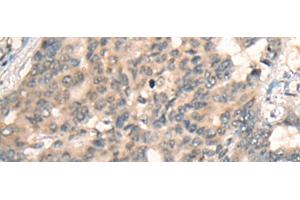 Immunohistochemistry of paraffin-embedded Human liver cancer tissue using BBOX1 Polyclonal Antibody at dilution of 1:45(x200) (BBOX1 anticorps)
