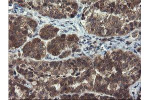 Immunohistochemical staining of paraffin-embedded Adenocarcinoma of Human ovary tissue using anti-MLF1 mouse monoclonal antibody. (MLF1 anticorps)
