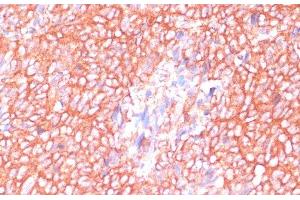 Immunohistochemistry of paraffin-embedded Human oophoroma using MOB4 Polyclonal Antibody at dilution of 1:100 (40x lens). (MOBKL3 anticorps)